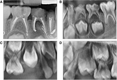 Case Report: Treatment and management of a child at high risk of caries